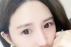 盐城假体隆鼻术后会透光吗？