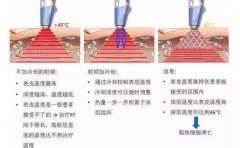 盐城射频溶脂减肥的优势是什么